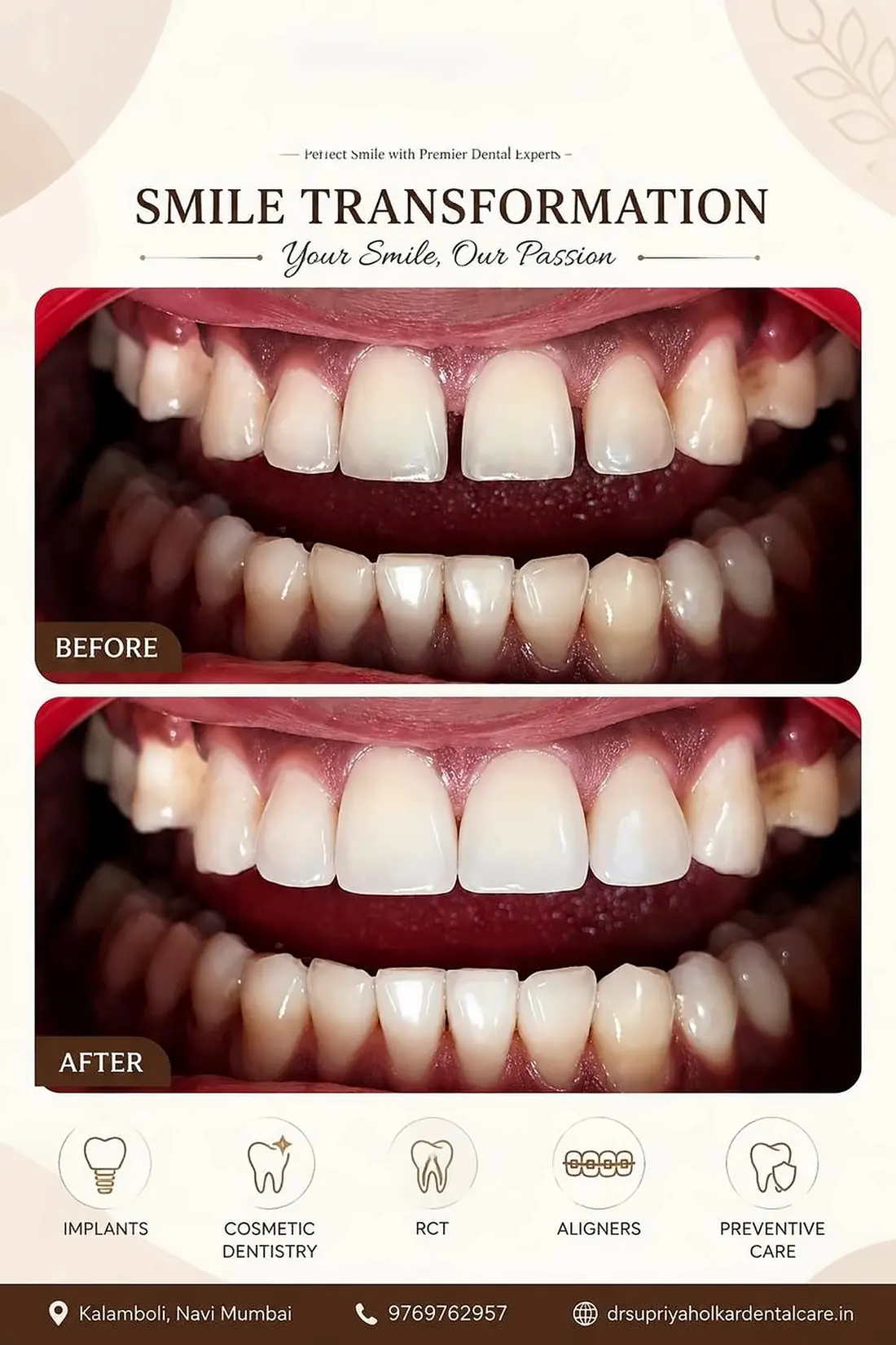 Smile transformation poster with before and after photos of front teeth