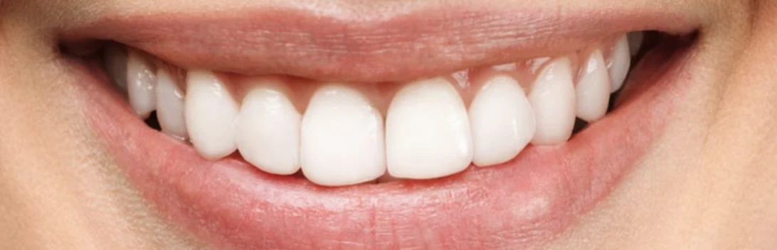 Smile after whitening: bright, even teeth