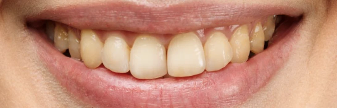 Smile before treatment: yellowed teeth